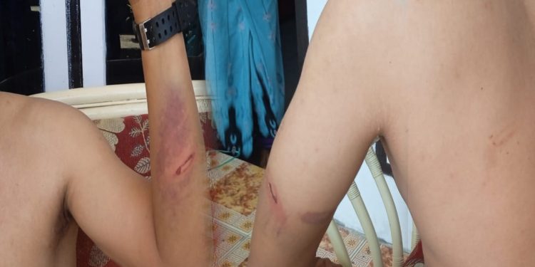 Oknum Polisi di Pohuwato Diduga Aniaya Warga Marisa Selatan Hingga Memar